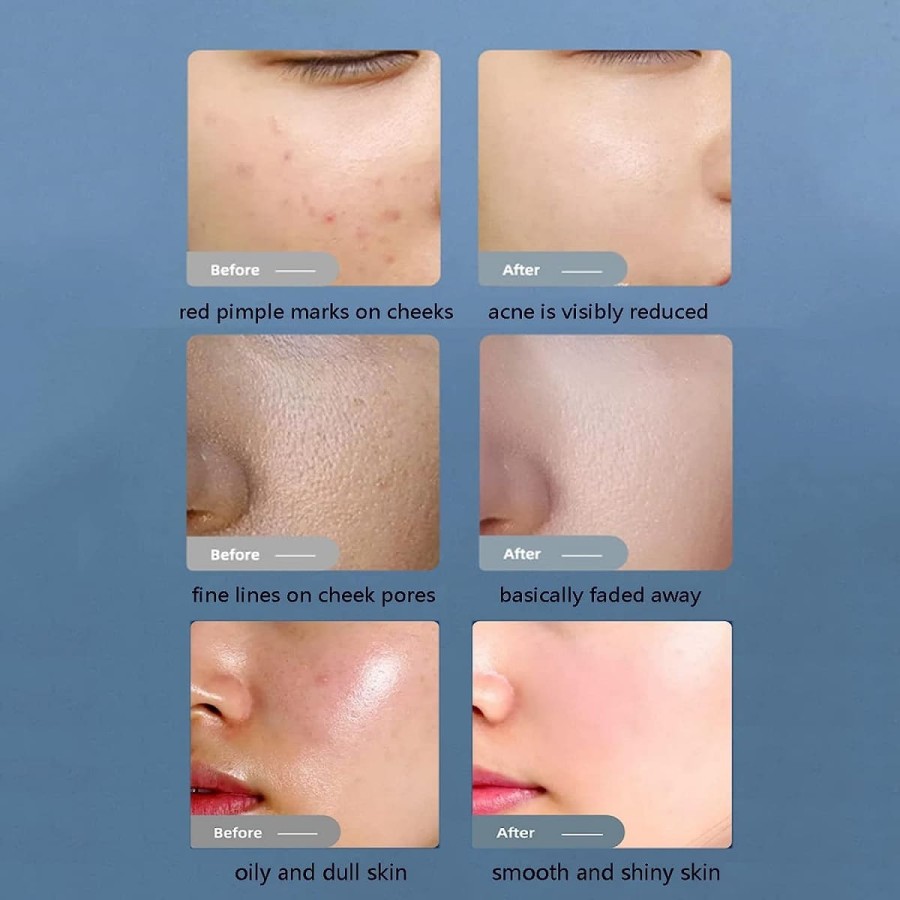 Dr.Beauty-medizinisches-professionelles-Wasser-Sauerstoff-Smart-Ice-Blue-Jet-Peel-Hautverjuengungsgeraet-2