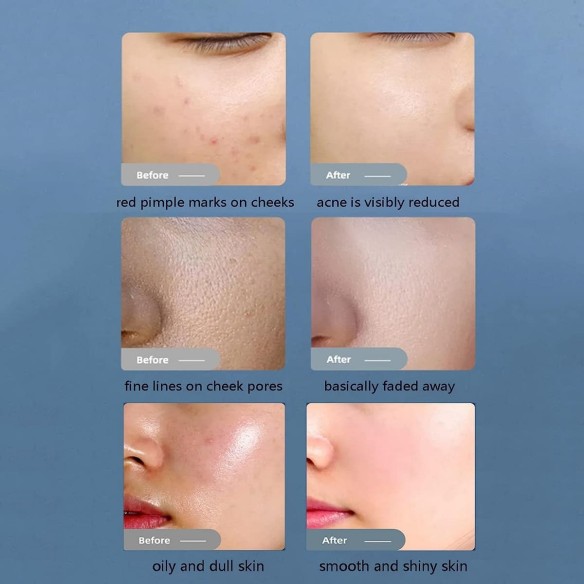 Dr.Beauty-medizinisches-professionelles-Wasser-Sauerstoff-Smart-Ice-Blue-Jet-Peel-Hautverjuengungsgeraet-2